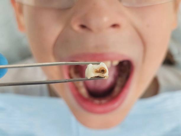 Best Root Canal Emergency Dentist  in Rossville, MD